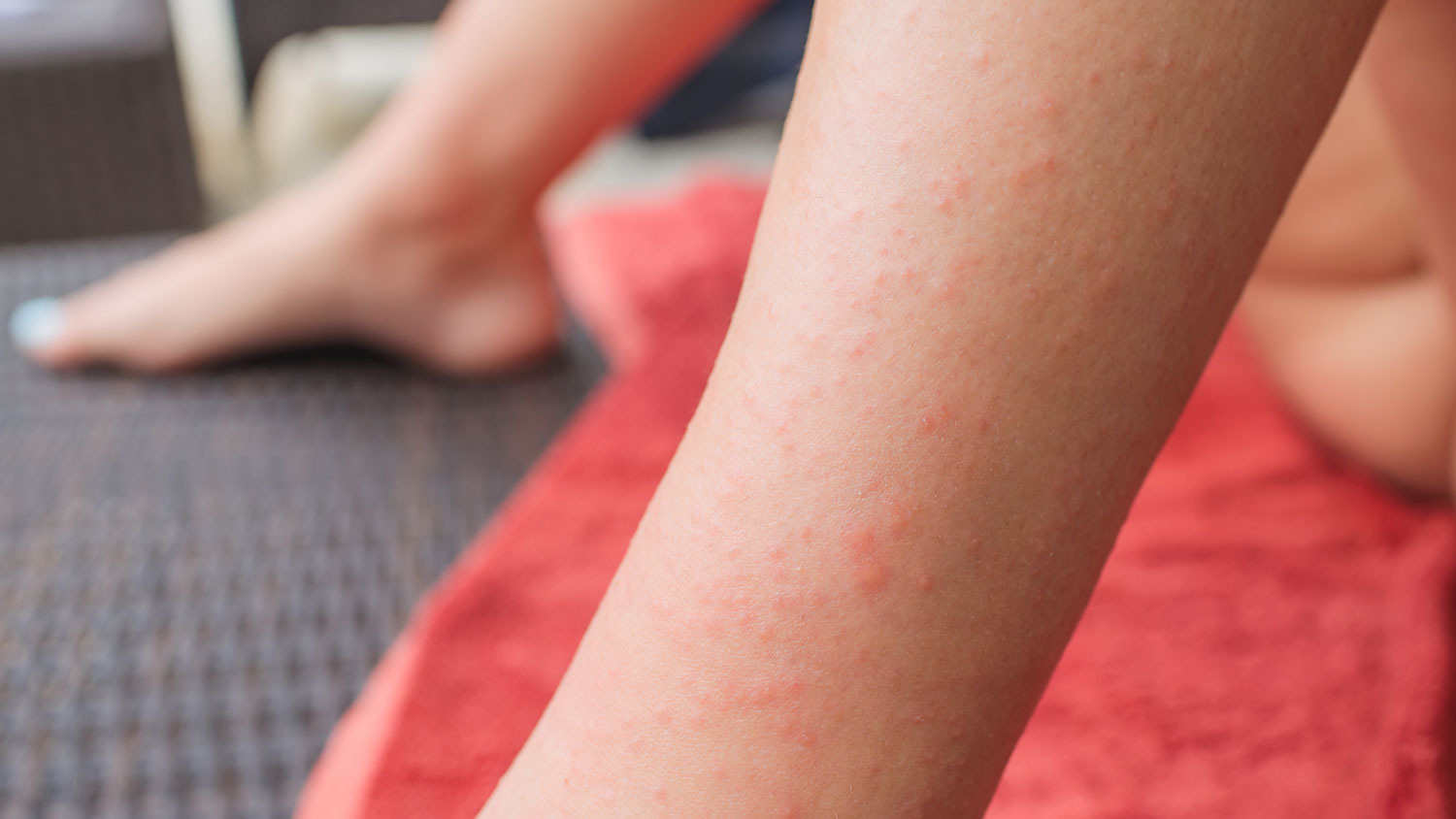 Rash on skin from mites