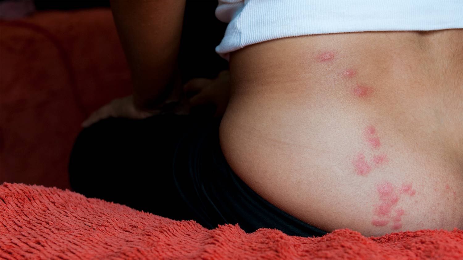 woman sitting on bed with bed bug bites  