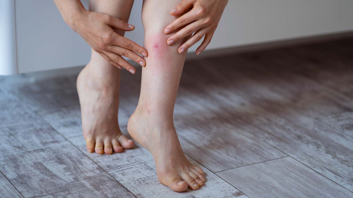 woman with bug bite on her leg