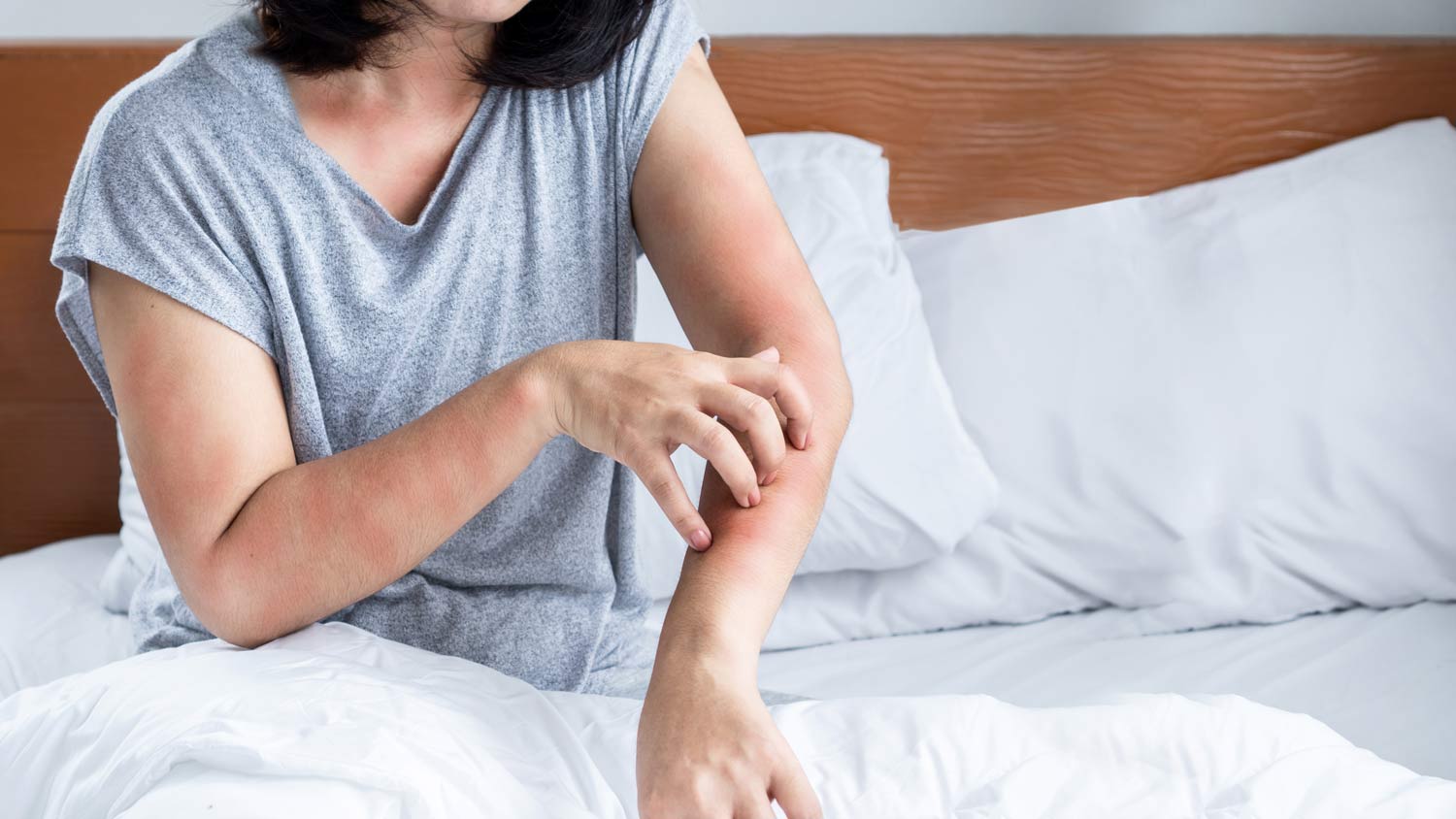 woman scratching from bug bites